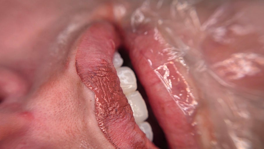 Close-up of lip enhancement at Timeless Beauty Aesthetics, Emalahleni, Mpumalanga, ZA.