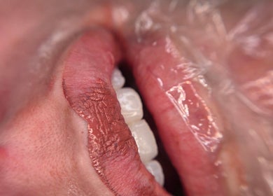 Close-up of lip enhancement at Timeless Beauty Aesthetics, Emalahleni, Mpumalanga, ZA.