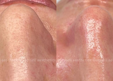 Before and after nose treatment at Diaphell Aesthetics, Grays, England, GB. Enhanced skin texture and glow.