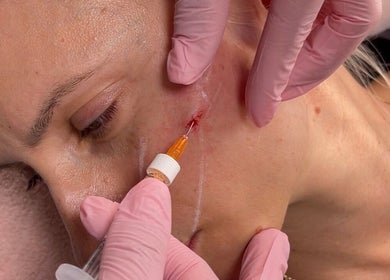 Facial treatment at Diaphell Aesthetics in Grays, England. Professional care with precision handling.