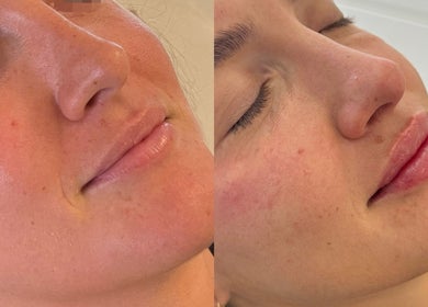 Before and after skin treatment results at Regen Clinic Norwich, showcasing improved complexion in Norwich, England, GB.