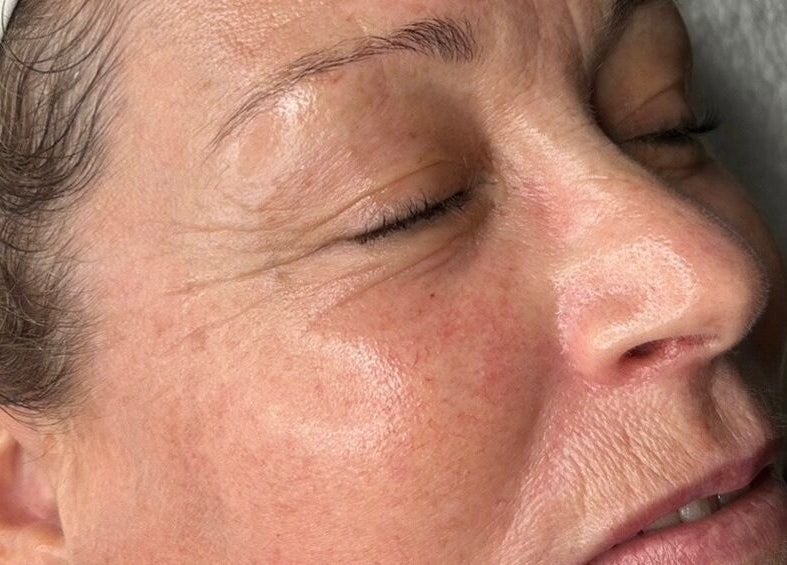 Close-up facial treatment at The Little Beauty Nest, Ilkeston, England, GB, highlighting skin care results.