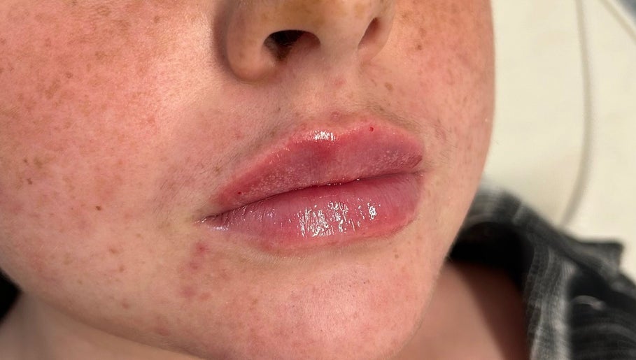 Close-up of glossy lips after treatment at SC Aesthetics, Ayr, Scotland, GB, showcasing natural enhancement.