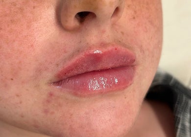 Close-up of glossy lips after treatment at SC Aesthetics, Ayr, Scotland, GB, showcasing natural enhancement.