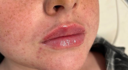 Close-up of glossy lips after treatment at SC Aesthetics, Ayr, Scotland, GB, showcasing natural enhancement.