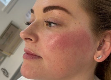 Close-up of glowing skin after treatment at SC Aesthetics, Ayr, Scotland, GB, showcasing facial rejuvenation.