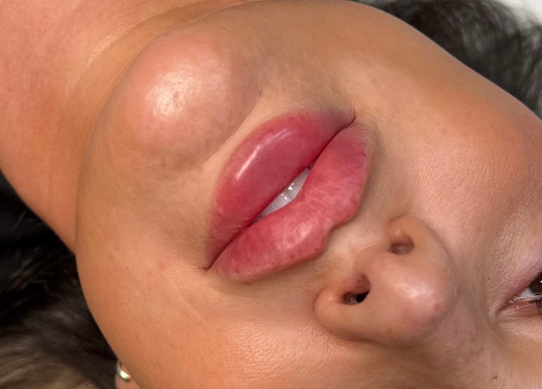 Close-up of enhanced lips at Profile by Leanne in Basingstoke, England, GB, showcasing beauty and wellness.