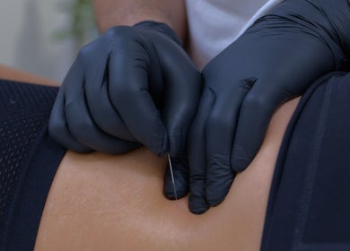 Θεραπευτική εφαρμογή βελονών στο Vesento Physiotherapy Nicosia Gesy, Νικόσια, Νικόσια, Κύπρος.