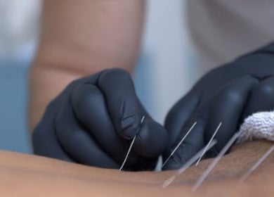 Θεραπευτικός βελονισμός στο Vesento Physiotherapy Nicosia Gesy, Νικόσια, Νικόσια, CY.