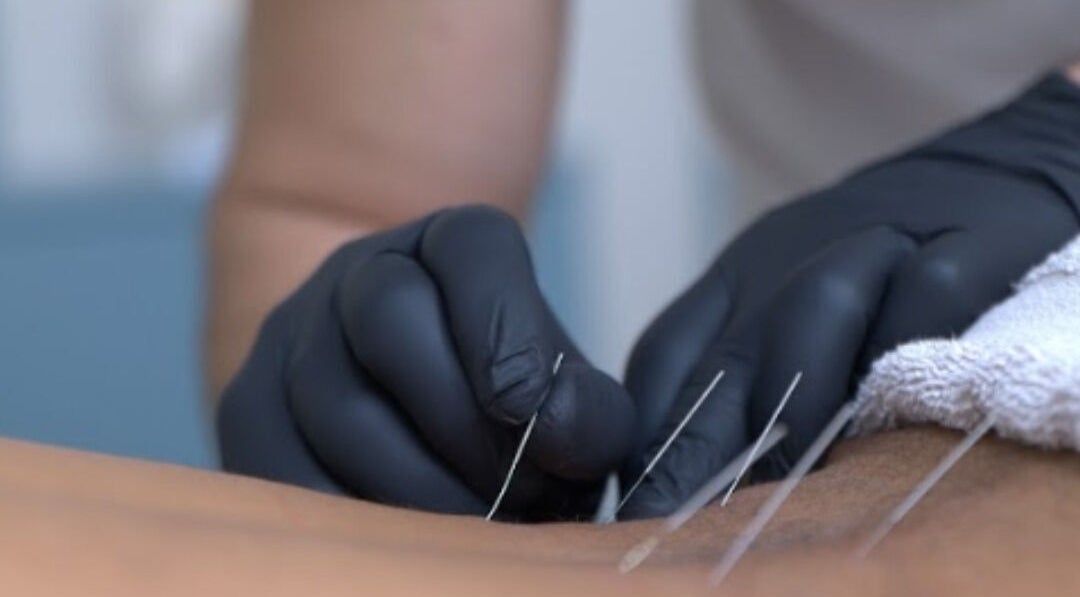 Θεραπευτικός βελονισμός στο Vesento Physiotherapy Nicosia Gesy, Νικόσια, Νικόσια, CY.