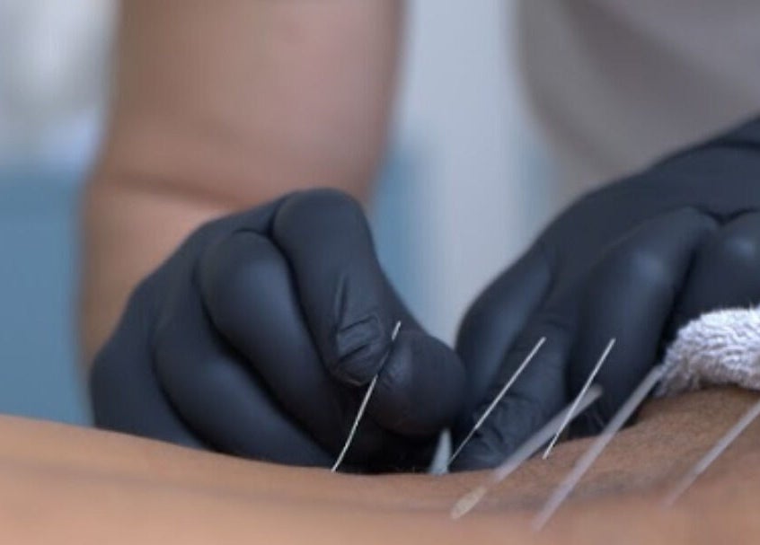Close-up of acupuncture treatment at Vesento Physiotherapy Limassol Gesy, Mesa Geitonia, Limassol, CY.