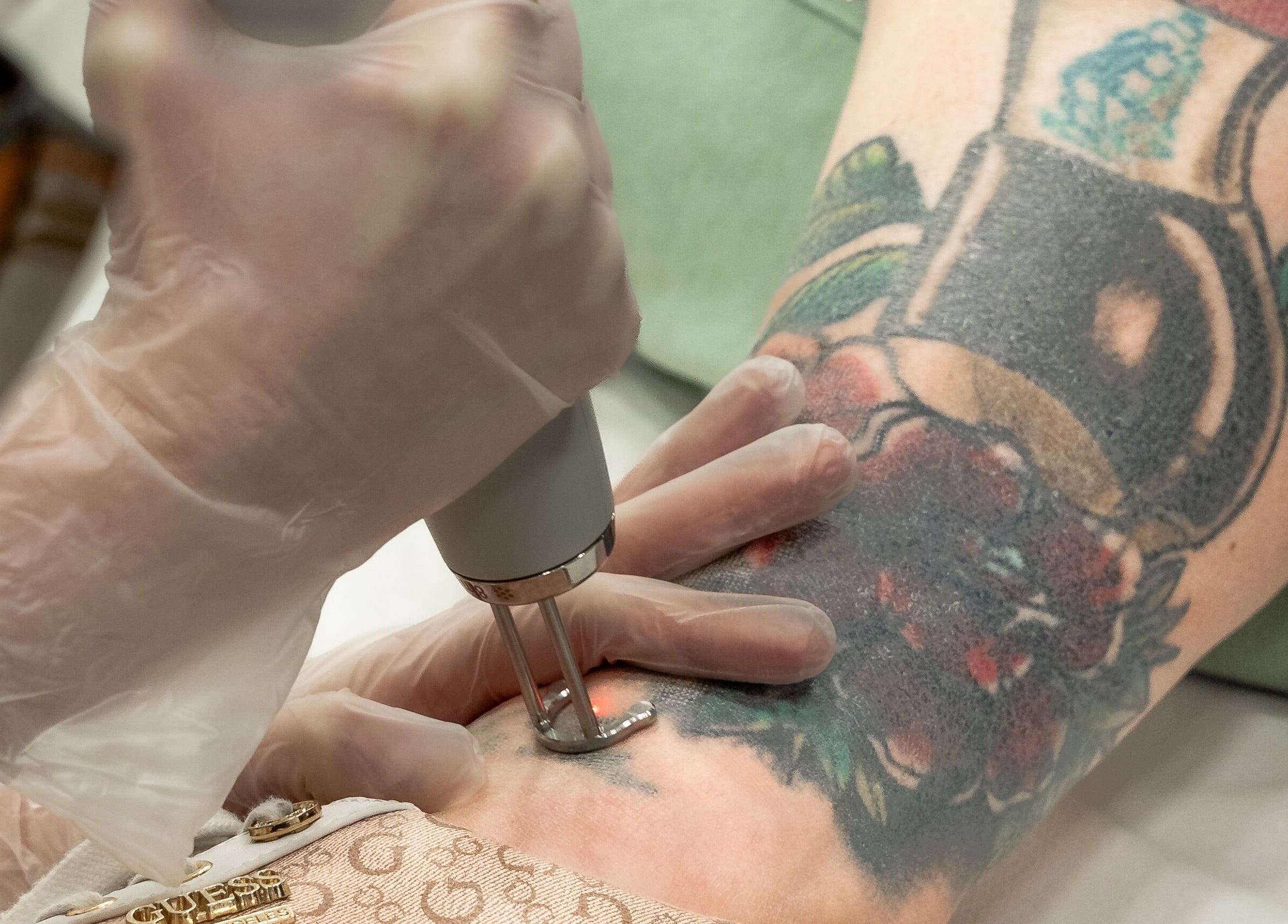 Tattoo removal in progress at HA Laser and Skin Studio Southampton SO30 2AU, Hedge End, England, GB.