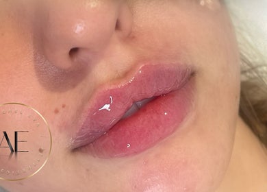 Close-up of glossy lips after treatment at AE Clinics - Abigael Eva (Sudbury), Sudbury, England, GB.
