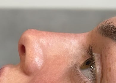 Closeup of a client's refined nose at AE Clinics - Abigael Eva (Colchester), Colchester, England, GB.