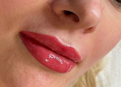 Glossy, vibrant lips enhanced at AE Clinics - Abigael Eva (Bury St Edmunds), Bury St Edmunds, England, GB.