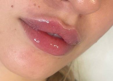 Close-up of glossy lips after treatment at AE Clinics (Haverhill), Haverhill, England, GB.