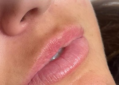 Close-up of enhanced lips at AE Clinics (Sudbury) in Sudbury, England, GB.