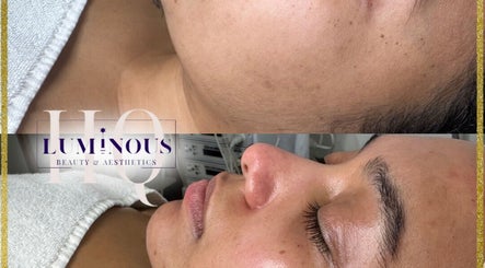 Before and after skin treatment at Luminous HQ, Enfield, England, GB showing improved complexion.