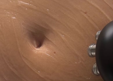 Radiofrequency device on skin at Sculpt and Shape Kent Skin & Body Clinic, Kings Hill, England, GB.