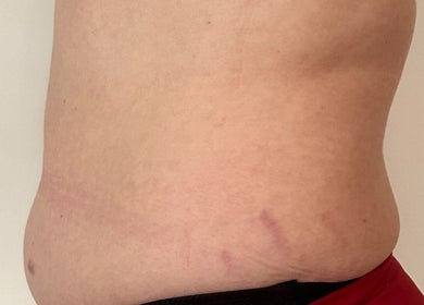 Body contouring treatment at Sculpt and Shape Kent Skin & Body Clinic, Kings Hill, England, GB.