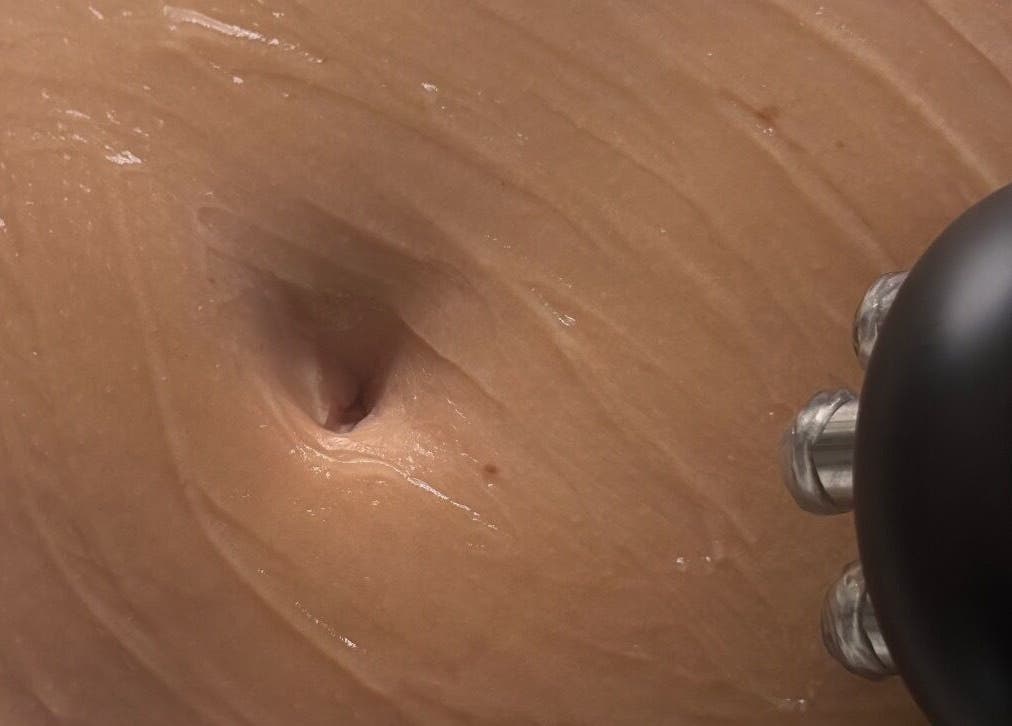 Body treatment at Sculpt and Shape Kent Skin & Body Clinic, Kings Hill, England, GB with advanced device.