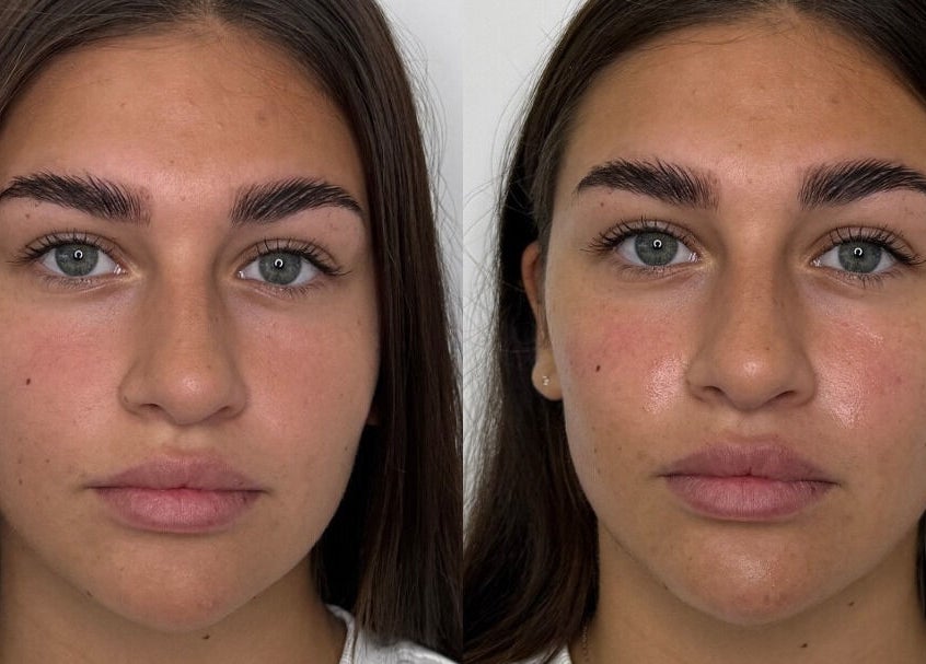 Before and after brow treatment at ASTHTX Clinic, Motherwell, Scotland, GB.