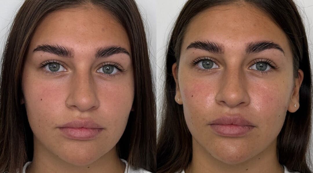 Before and after brow treatment at ASTHTX Clinic, Motherwell, Scotland, GB.