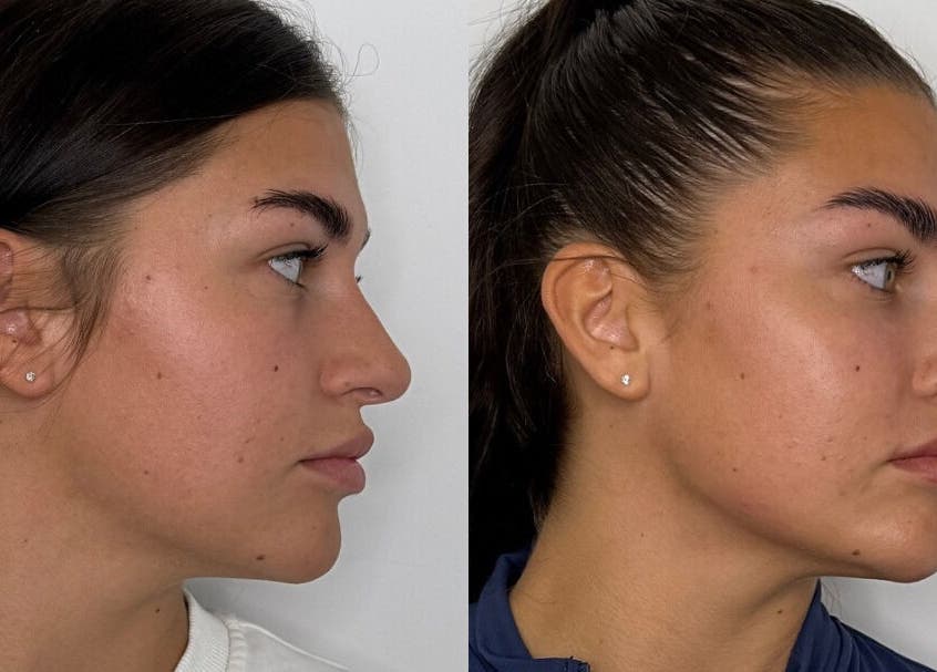 Before and after skin treatment at ASTHTX Clinic, Motherwell, Scotland, GB showcasing enhanced facial skin smoothness.