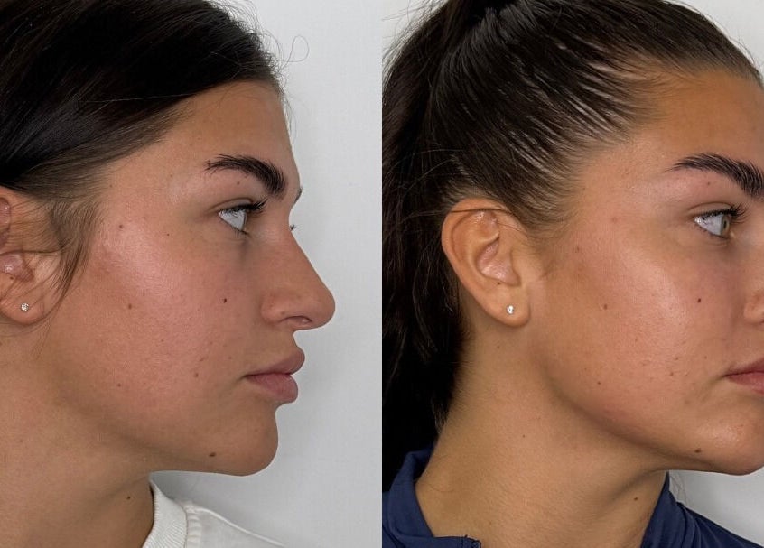 Before and after skin treatment at ASTHTX Clinic, Motherwell, Scotland, GB showcasing enhanced facial skin smoothness.