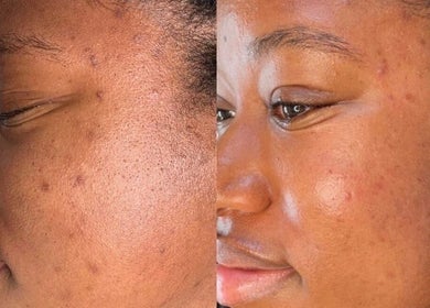 Before and after skin treatment at Totally Glam - Northgate Office Park, Sandton, Gauteng, ZA.