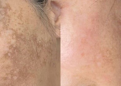 Before and after skincare treatment at Totally Glam - Northgate Office Park, Sandton, Gauteng, ZA.