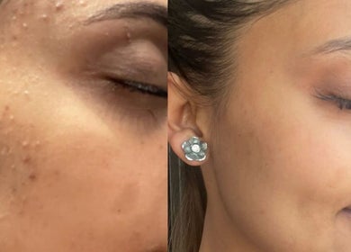 Before and after skin treatment at Totally Glam - Northgate Office Park, Sandton, Gauteng, ZA showing clear complexion.