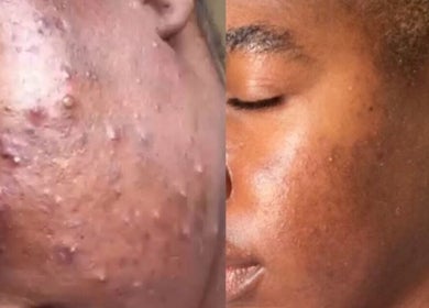 Before and after skin treatment at Totally Glam - Northgate Office Park, Sandton, Gauteng, ZA