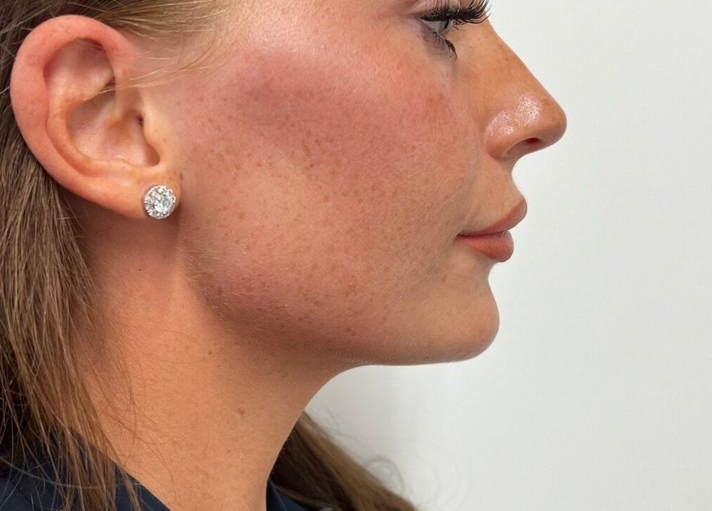 Elegant side profile of a woman at AJ Aesthetics Lounge, Paddock Wood, England, GB.