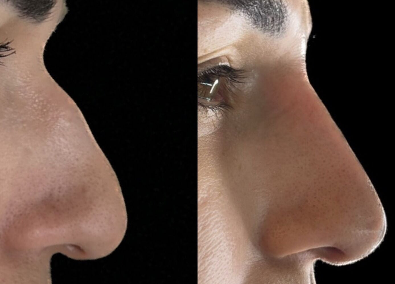 Before and after nose enhancement at AJ Aesthetics Lounge, Paddock Wood, England, GB.