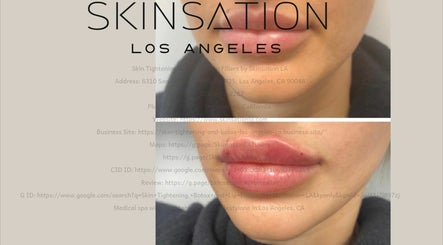 Skin Tightening, Botox and Lip Fillers by Skinsation LA image 3
