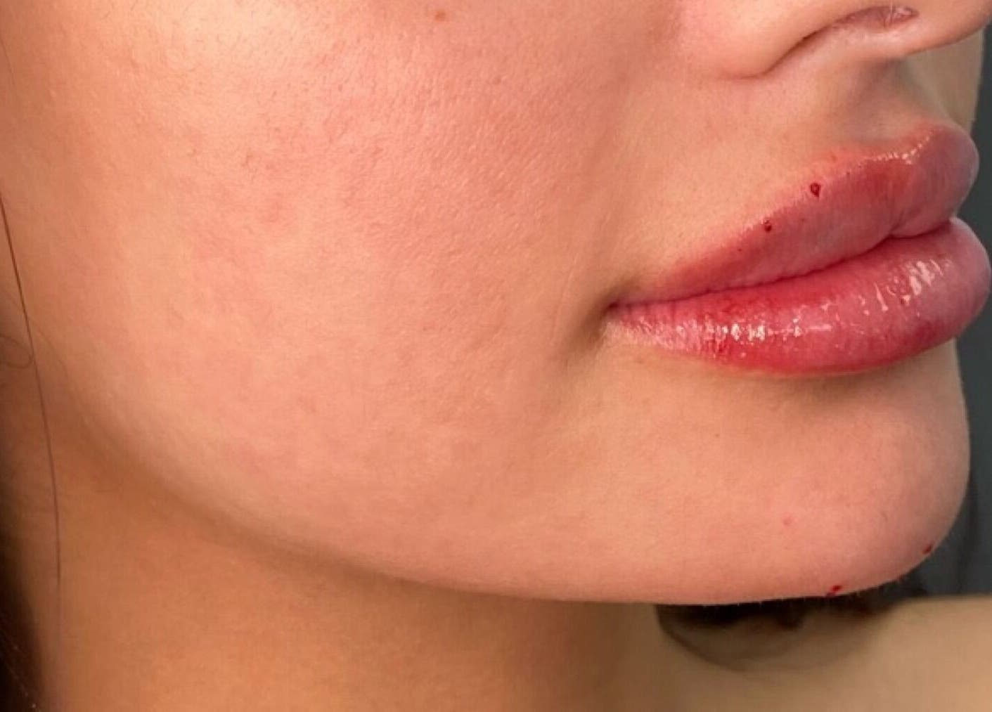 Smooth, enhanced lips after treatment at Skinsation LA | Skin Tightening, Botox and Lip Fillers in Los Angeles, California, US.