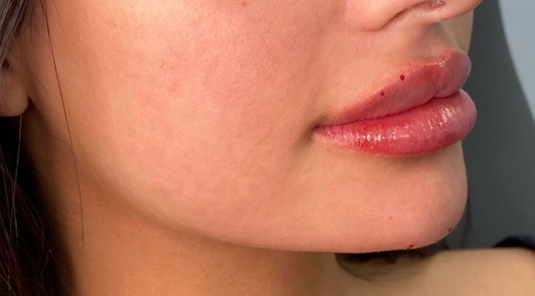 Smooth, enhanced lips after treatment at Skinsation LA | Skin Tightening, Botox and Lip Fillers in Los Angeles, California, US.