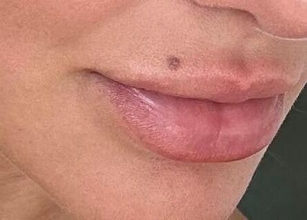Close-up of enhanced lips at Skinsation LA | Skin Tightening, Botox and Lip Fillers by Skinsation LA, Los Angeles, California, US.
