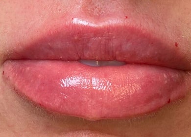 Close-up of glossy enhanced lips at The London Dolls Aesthetics, London, England, GB.