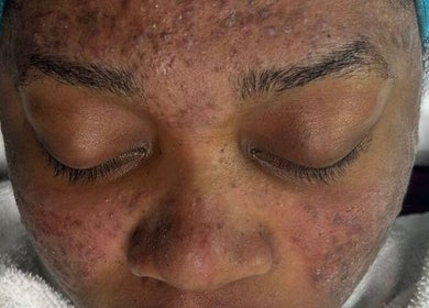 Close-up of facial skin treatment at The Beauty Boss Bureau, Nassau, New Providence, BS.