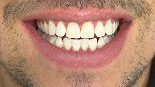 Sydney Teeth Whitening