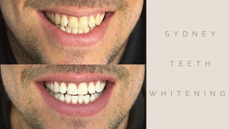 Sydney Teeth Whitening Bild 1