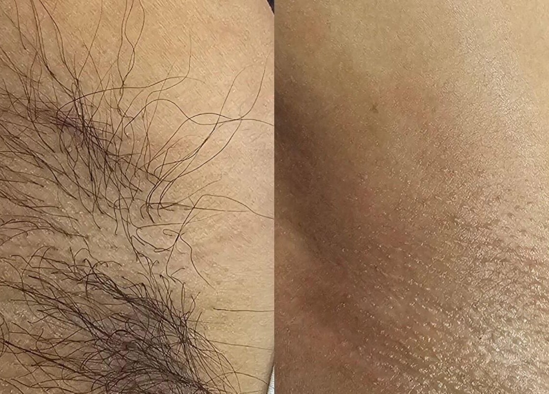 Before and after waxing at Giselle Wax Room, Curepe, TT showing smooth skin results.
