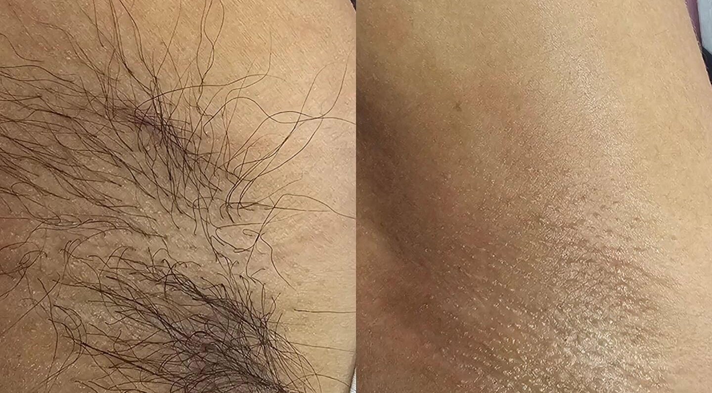 Before and after waxing at Giselle Wax Room, Curepe, TT showing smooth skin results.