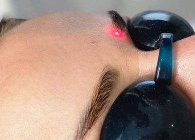 Laser treatment on forehead at Bonlaser by Essence, Kralendijk, Bonaire, BQ. Precision beauty care in action.