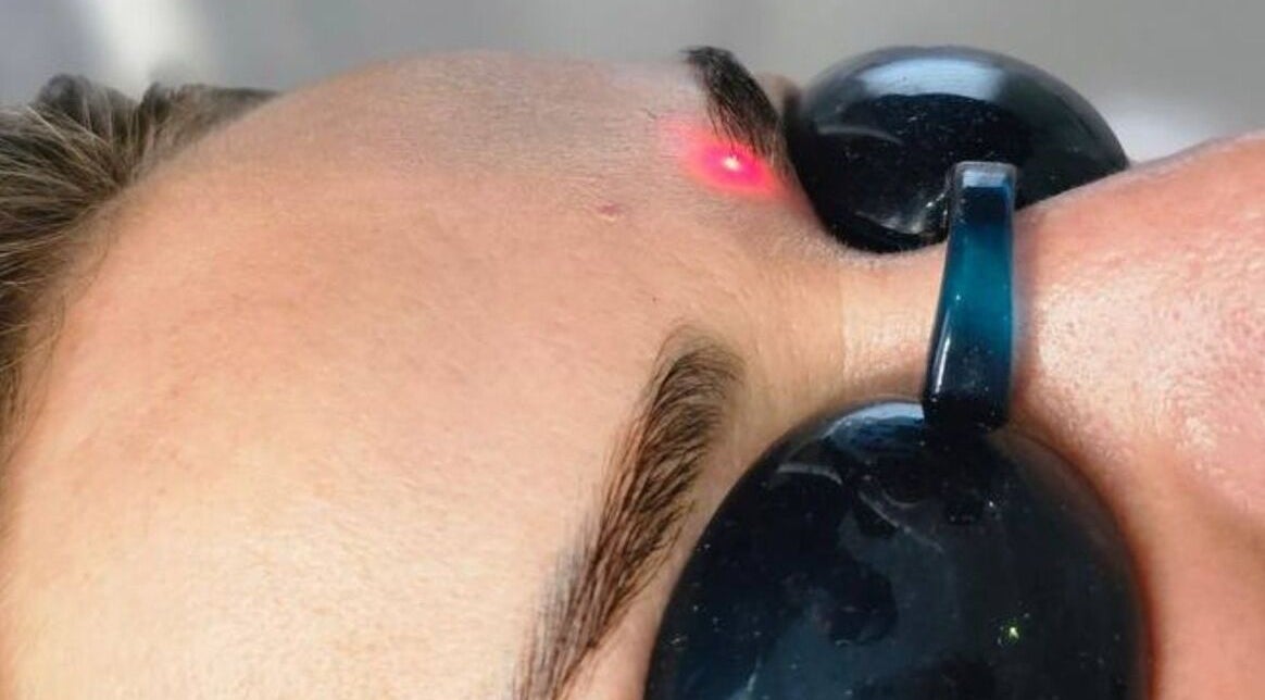 Laser treatment on forehead at Bonlaser by Essence, Kralendijk, Bonaire, BQ. Precision beauty care in action.