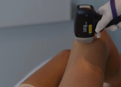 Laser treatment on leg at Miro Beauty Clinic, Dublin15, County Dublin, IE.