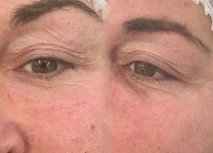 Close-up before and after eye rejuvenation at Eye Me Up Aesthetics, Rainham, England, GB.