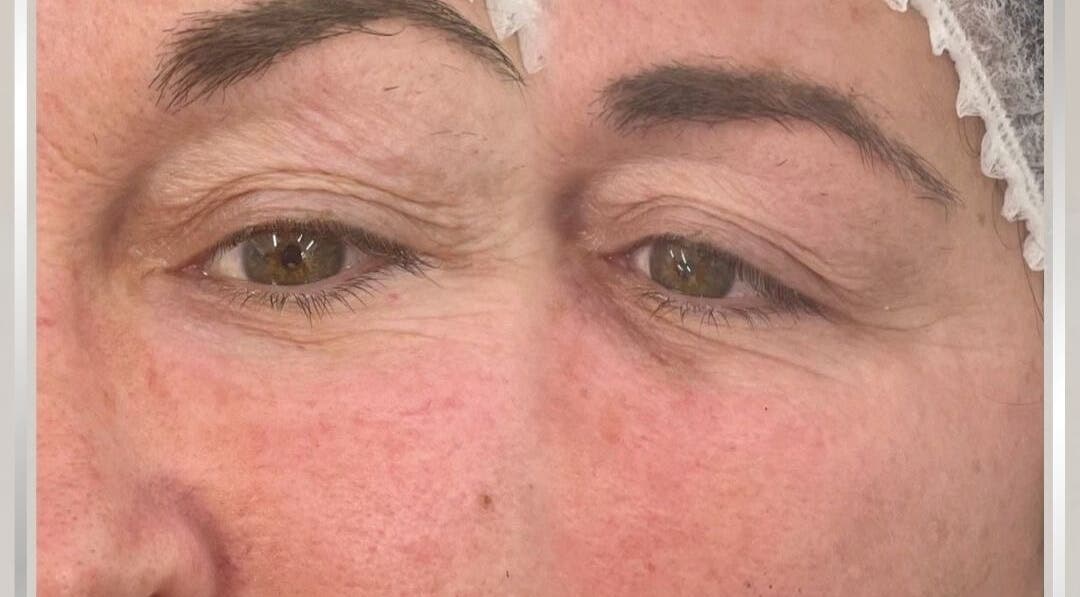 Close-up before and after eye rejuvenation at Eye Me Up Aesthetics, Rainham, England, GB.